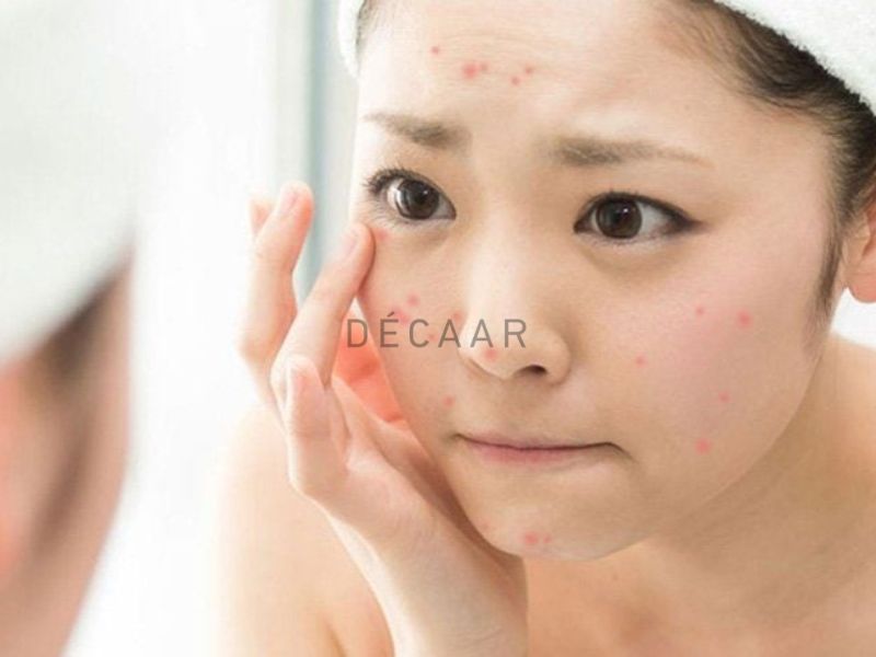 nguyên nhân mụn trứng cá bọc